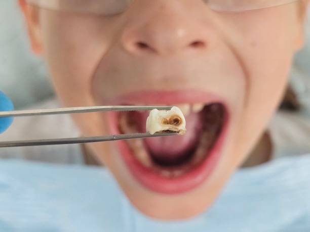 Best Emergency Dental Extractions in Garberville, CA